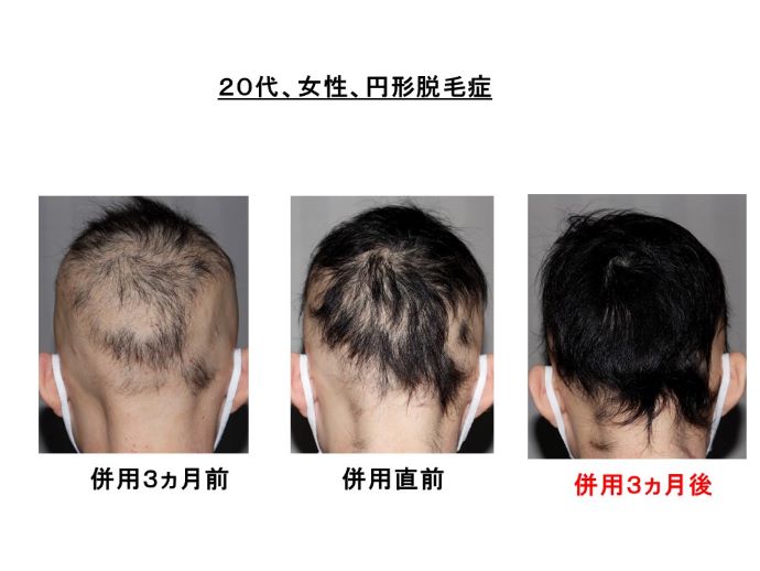 円形脱毛症　病院